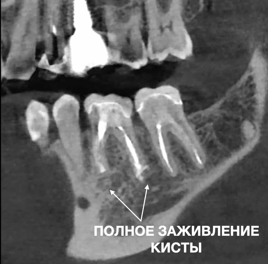 Лікування кореневих каналів зубів під мікроскопом
